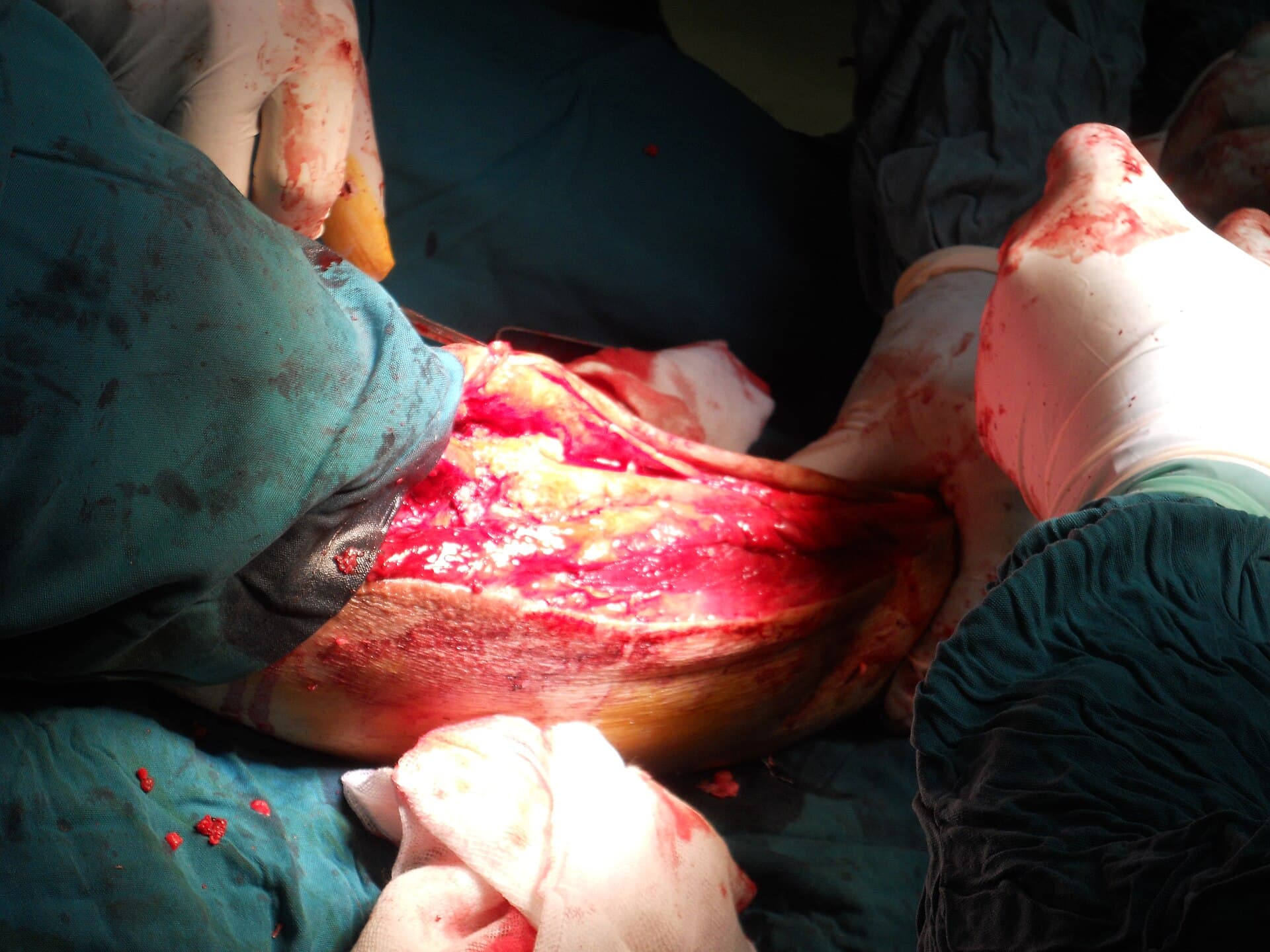 Orthopedic surgery in progress